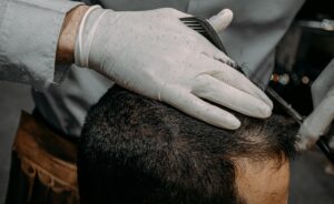 hair transplant