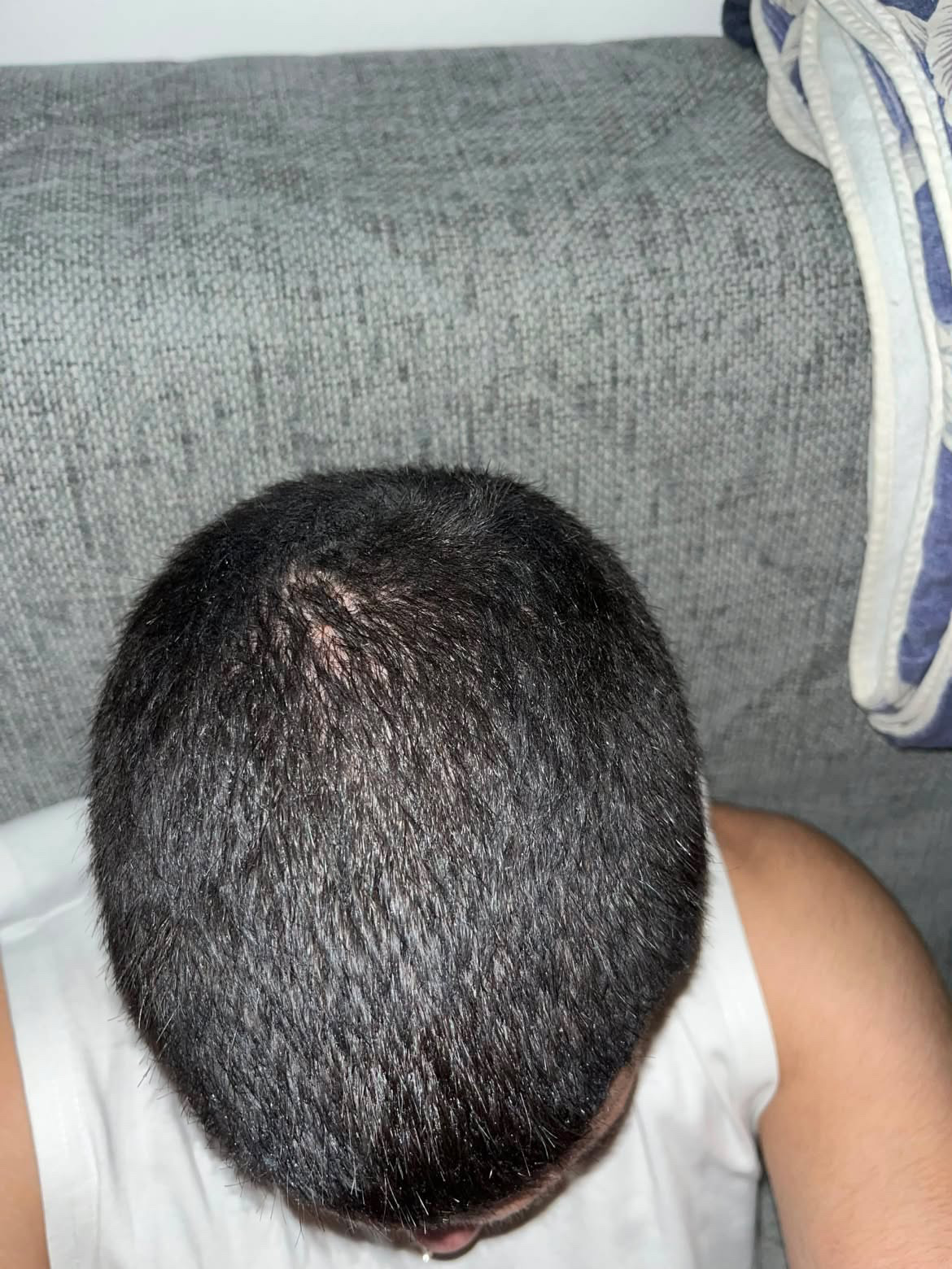 BA 14 - After treatment