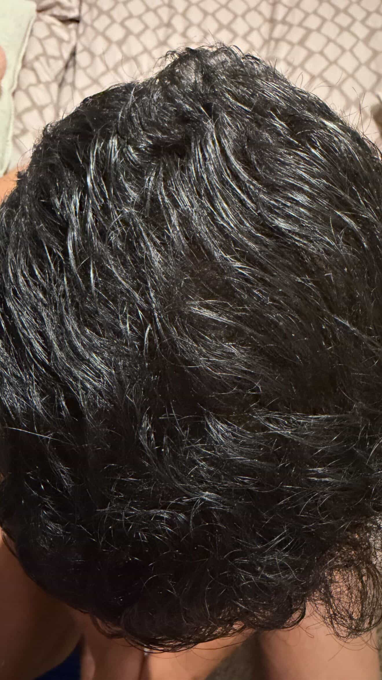 BA 3 - After treatment