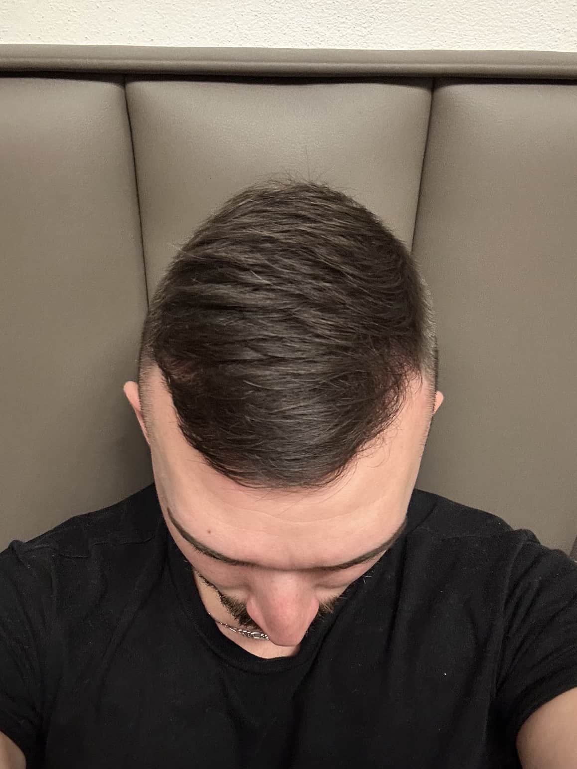 BA 10 - After treatment