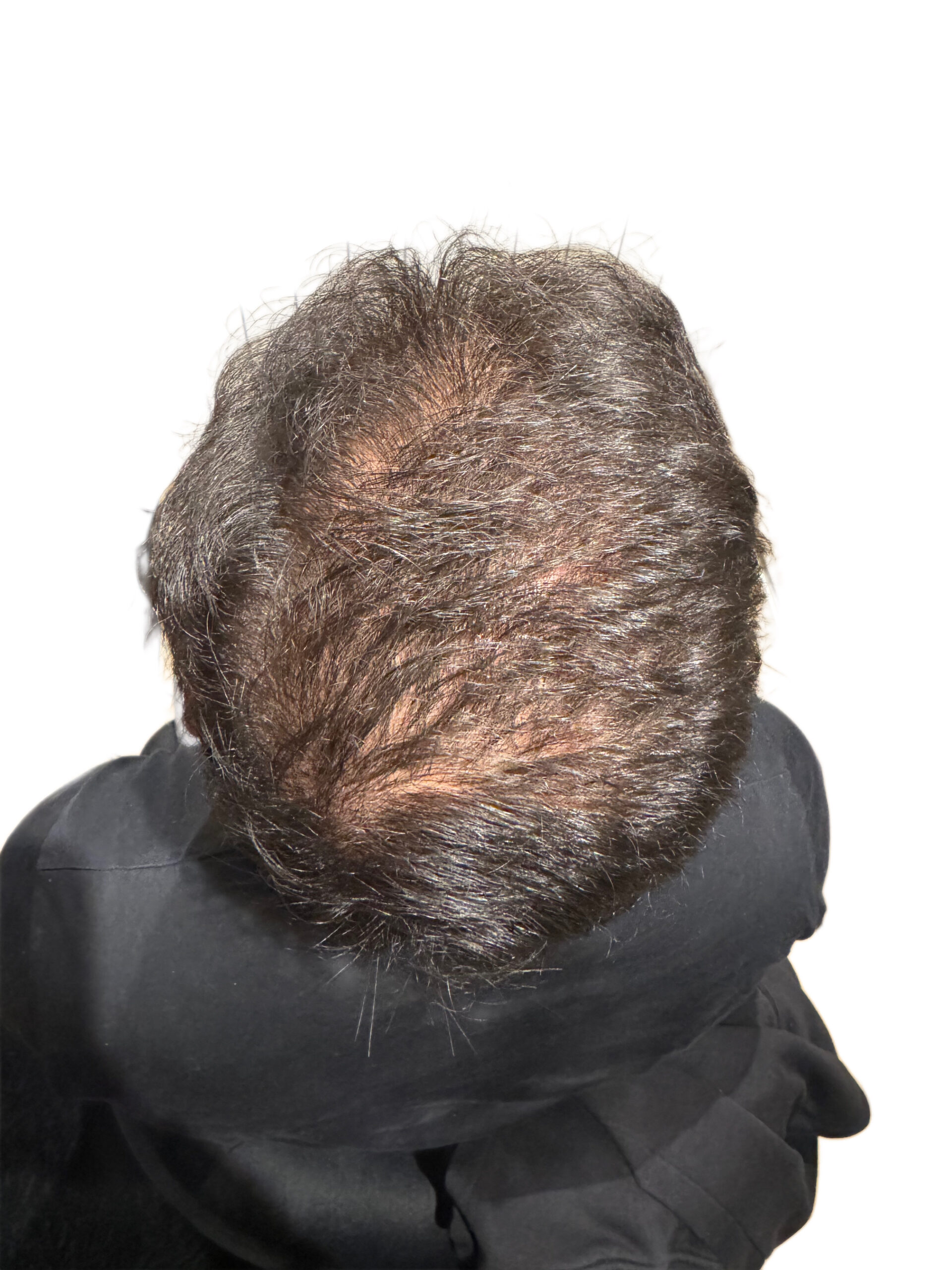 BA 11 - Before treatment