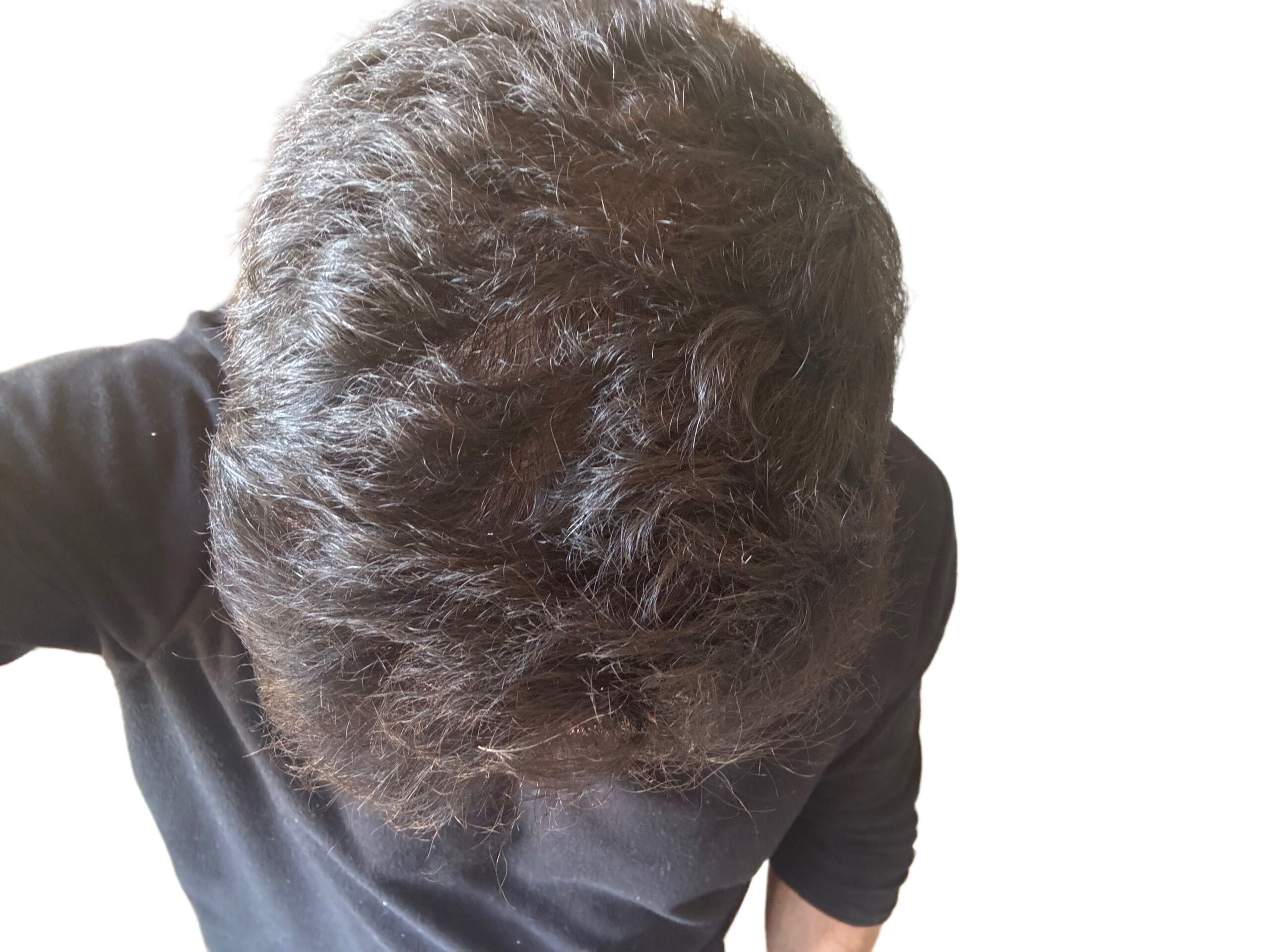 BA 11 - After treatment