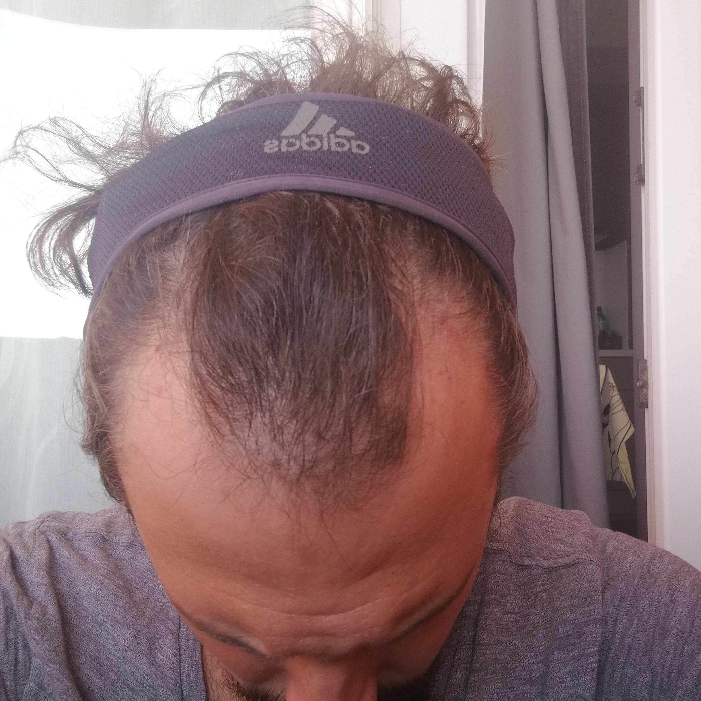 BA 5 - Before treatment