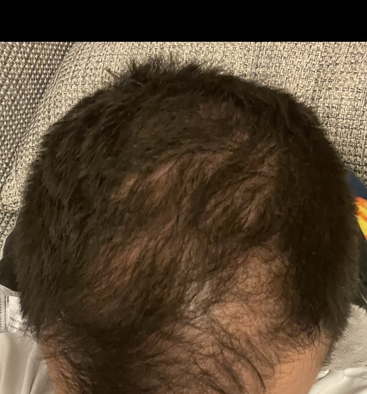 BA 13 - Before treatment