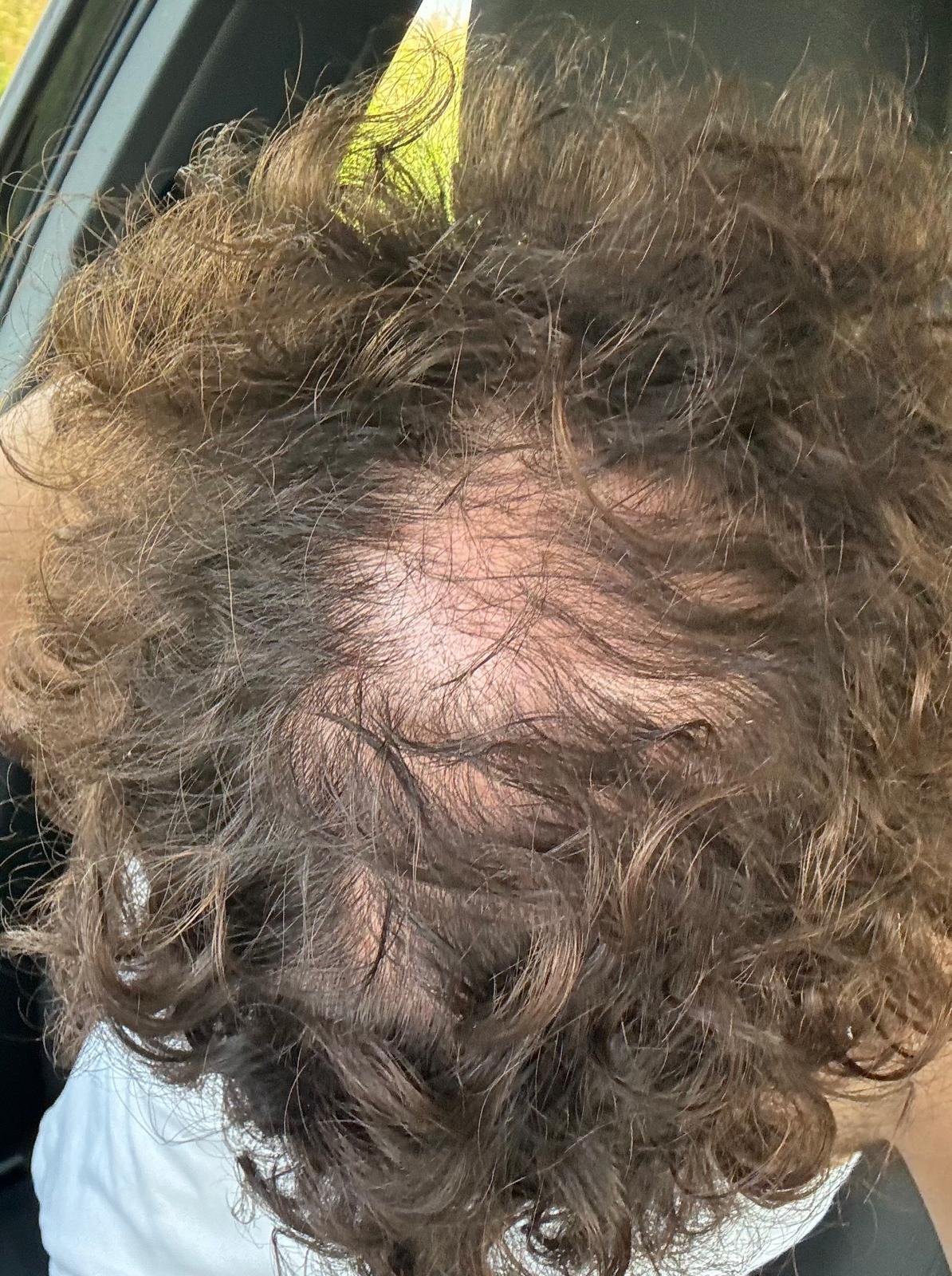 B/A 1 - Before treatment