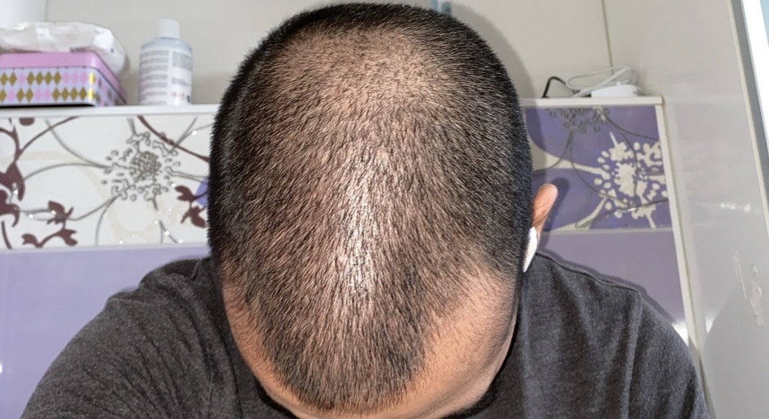 B/A 2 - Before treatment