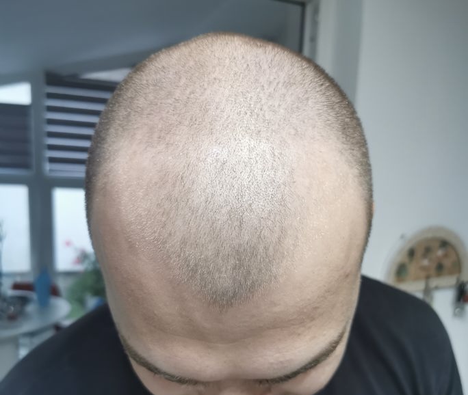 BA 16 - Before treatment