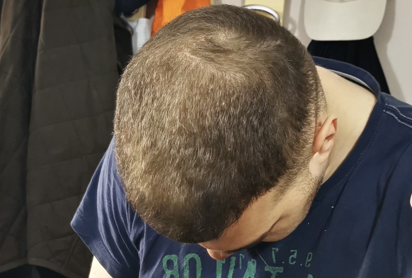 BA 16 - After treatment